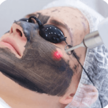 Q-switched Nd:Yag Laser